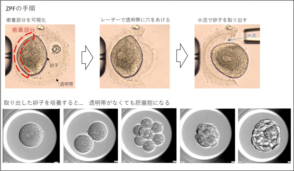 「人為的透明帯除去培養法(ZPF)」について