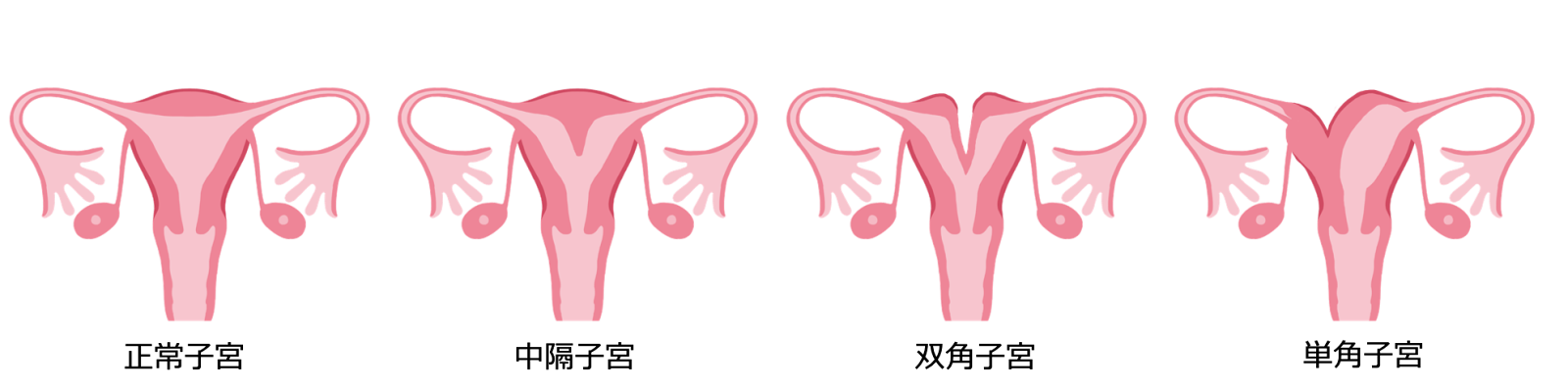 子宮形態異常について