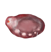 黄体化未破裂卵胞について