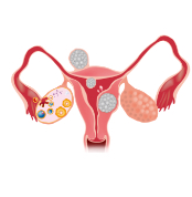 子宮筋腫について