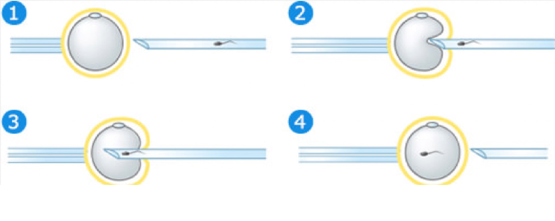 顕微授精のイメージ図